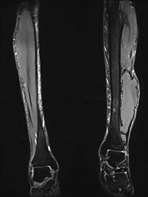 Myositis ossificans | Radiology Reference Article | Radiopaedia.org