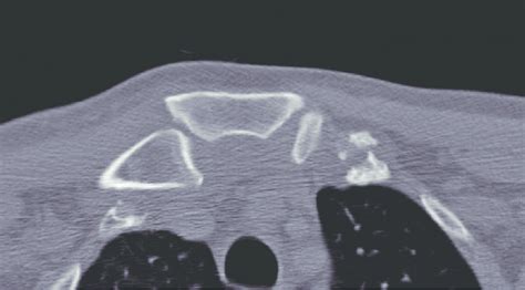 Computed tomography scan showing dislocation of the sternoclavicular ...