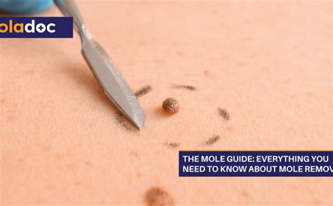 The Mole Guide: Everything You Need To Know About Mole Removal | Beauty and Skin Care | oladoc.com