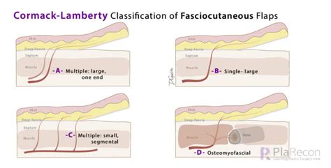 Fasciocutaneous Flap Classifications- Cormack and Lamberty, Mathes and Nahai, Nakajima