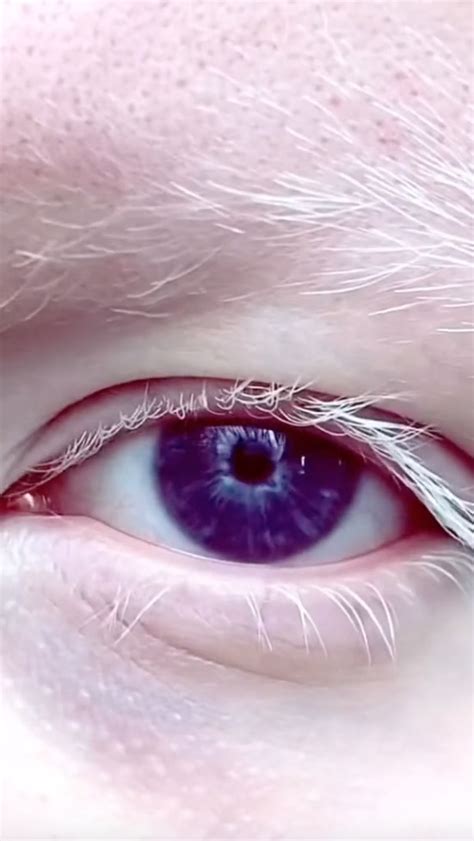 'People tell me I'm too bright to look at ,' says Albino woman with PURPLE EYES | Need To Know