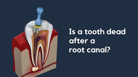 Dead tooth root canal before and after | Hummingbird Dental | Voted Top Choice Richmond Hill Dentist