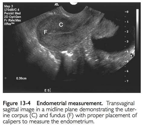 UTERINE ULTRASOUND IMAGING