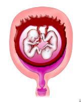 McCulloch's Monoamniotic Twins Journey: A Brief Explanation