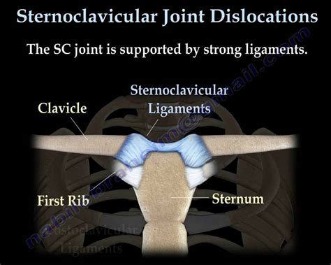 Sternoclavicular joint Dislocations - Everything You Need To Know - Dr. Nabil Ebraheim - YouTube