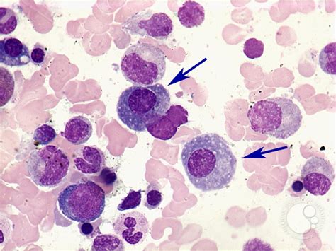 Plasma cells - 1.