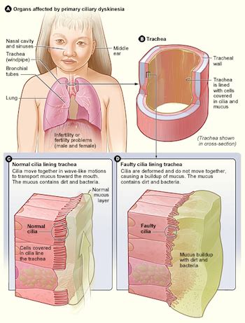 Primary Ciliary Dyskinesia: Symptoms & Diagnosis | Study.com