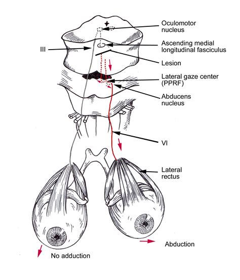 Vertebrobasilar Stroke | Anatomy, Eye health, Internuclear ophthalmoplegia