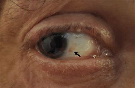 Nyctalopia and Xerophthalmia in a Patient With Crohn’s Induced Vitamin ...