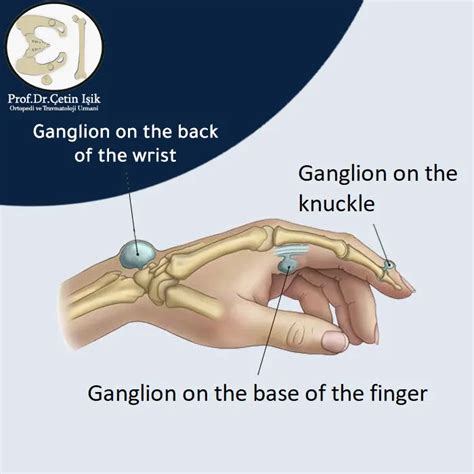 Ganglion cyst in the hand, symptoms and treatment - Dr. What's wrong with you?