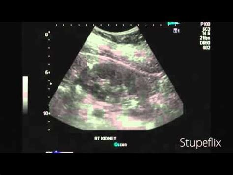 Ultrasound imaging: Sonography of angiomyolipoma: