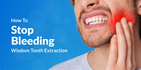 How To Stop Bleeding After Wisdom Tooth Extraction - LA Dental Clinic