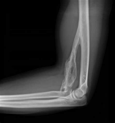 Myositis ossificans | Radiology Reference Article | Radiopaedia.org