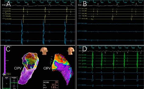 Figure 4 from Pulsed-Field Ablation Using a Novel Ablation-Mapping ...