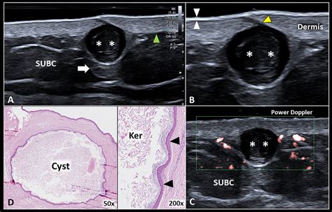 Epidermal inclusion cyst of the axilla. A hypoechoic and rounded... | Download Scientific Diagram