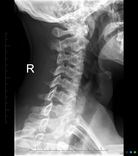 Normal Radiographic Anatomy Of The Cervical Spine Anatomy Radiology | sexiezpix Web Porn