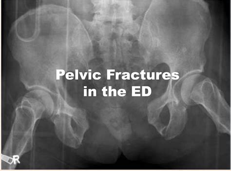 Icd Code 9 For After Care Of Pelvic Fractures