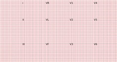 Computech Ecg Paper, Less than 80, 80mm x 20m at Rs 500/roll in Mumbai ...