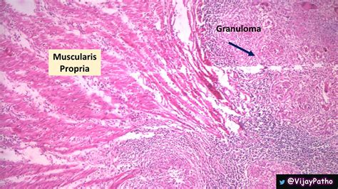 Intestinal Tuberculosis - Pathology Made Simple