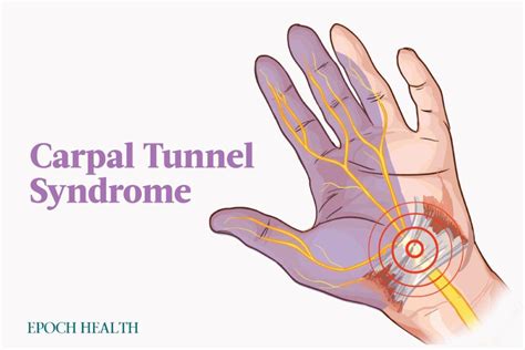 Carpal Tunnel Syndrome | The Epoch Times