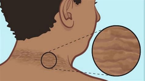 Black spots of the skin are called Acanthosis Nigricans, this skin ...