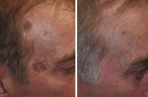 Seborrheic Keratosis: old age spots