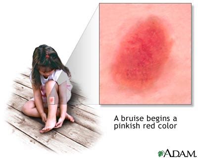 Bruise healing - series—Indications: MedlinePlus Medical Encyclopedia