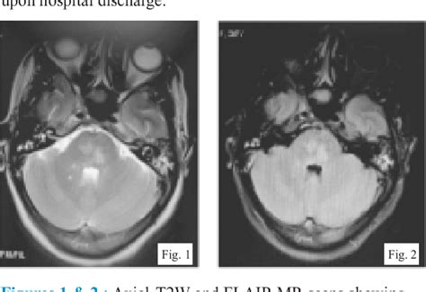 Figure 1 from Early Detection of Central Pontine Myelinolysis with MRI ...