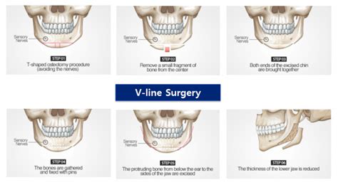 Different types of jaw surgeries: Square jaw, V-line and Mini V-line