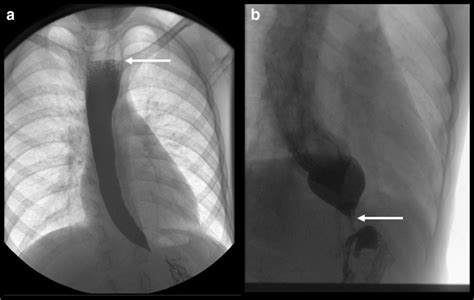 Esophagram of a patient with achalasia. a An air-fluid level in the... | Download Scientific Diagram