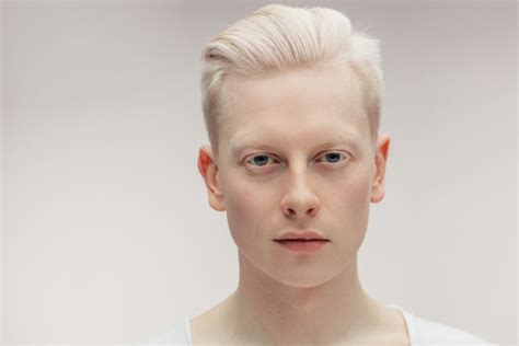 ALBINISM – Dermatology Conditions and Treatments