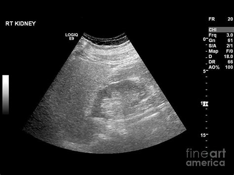 Liver Mass, Ultrasound Scan Photograph by Science Photo Library - Pixels