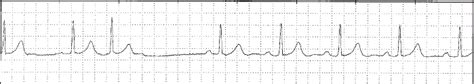 Supraventricular Ectopic Beat - CardiacMonitoring.com