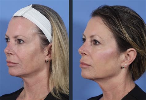 FaceTite | Blog | Savannah Facial Plastic Surgery