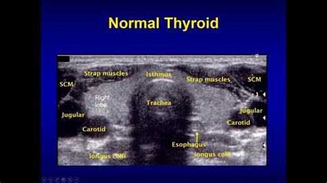 Neck ultrasonography | Thyroid ultrasound, Diagnostic medical sonography, Ultrasound sonography