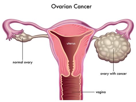 Pcos Ovary Size