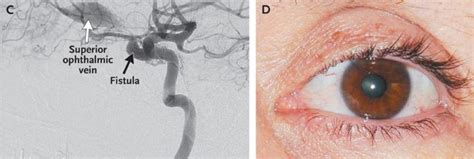 Carotid–Cavernous Sinus Fistula – MediHelp