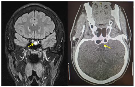 Biomedicines | Free Full-Text | Pituitary Apoplexy in Patients with ...