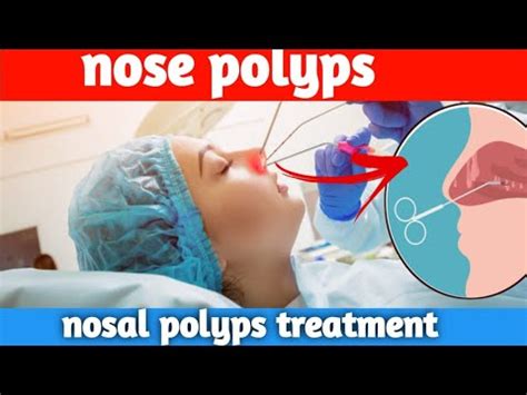 nose polyp | nasal polyps remove| sinus polyps removal| polypectomy 3d animation | Ak ...