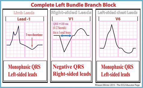 ECG Educator Blog : 03/09/16