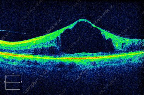 Diabetic macular oedema, OCT scan - Stock Image - C057/0660 - Science Photo Library