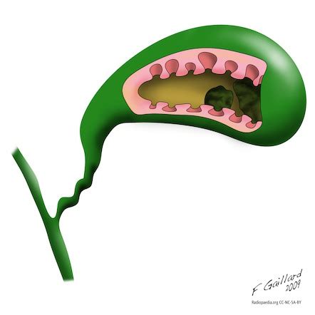 Pearl necklace sign | Radiology Reference Article | Radiopaedia.org