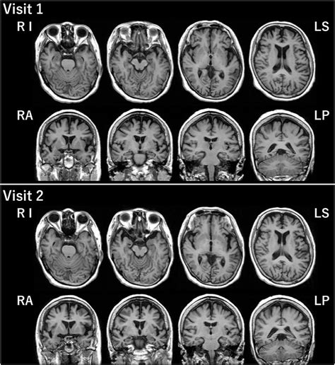 Frontiers | Primary Progressive Aphasia as a Prodromal State of Dementia With Lewy Bodies: A ...