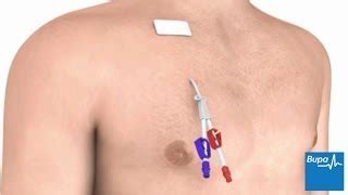 Tunneled Central Venous Catheter