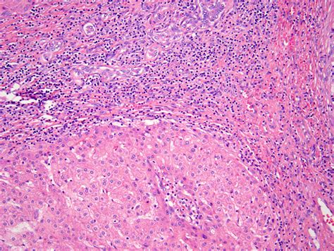 Focal Nodular Hyperplasia Histology