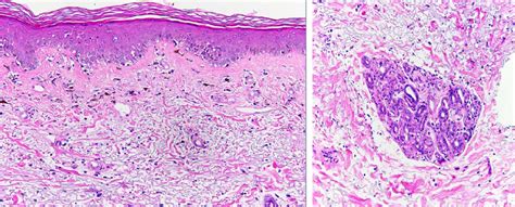 Biopsy demonstrates burned out lichenoid interface dermatitis with... | Download Scientific Diagram