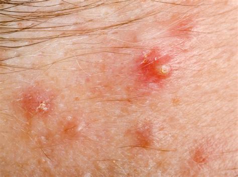 What Is Pityrosporum Folliculitis? (with pictures)