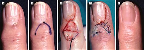 Skin Excision and Osteophyte Removal Is Not Required in the Surgical ...