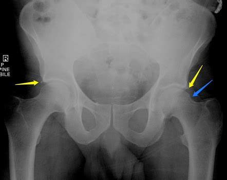 Os acetabuli | Radiology Reference Article | Radiopaedia.org