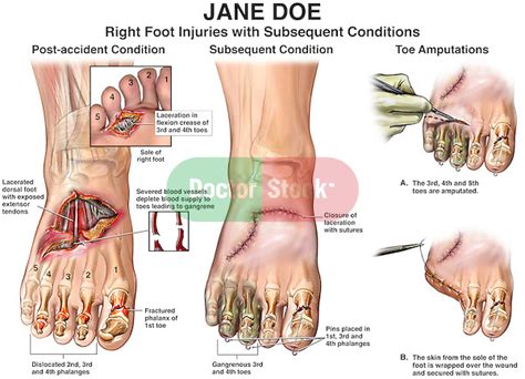 2019 Icd 10 Code For Amputation Of Toes